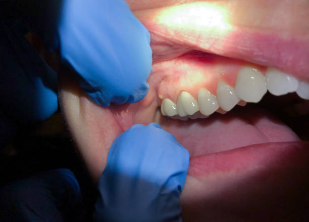 Best Emergency Wisdom Tooth Extraction in USA